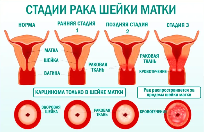 стадии рака шейки матки