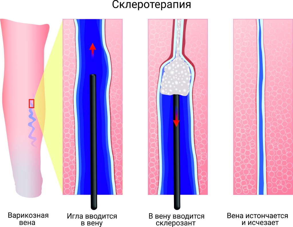 skleroterapiya