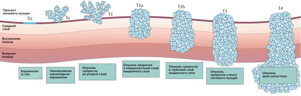 Рак мочевого пузыря у мужчин