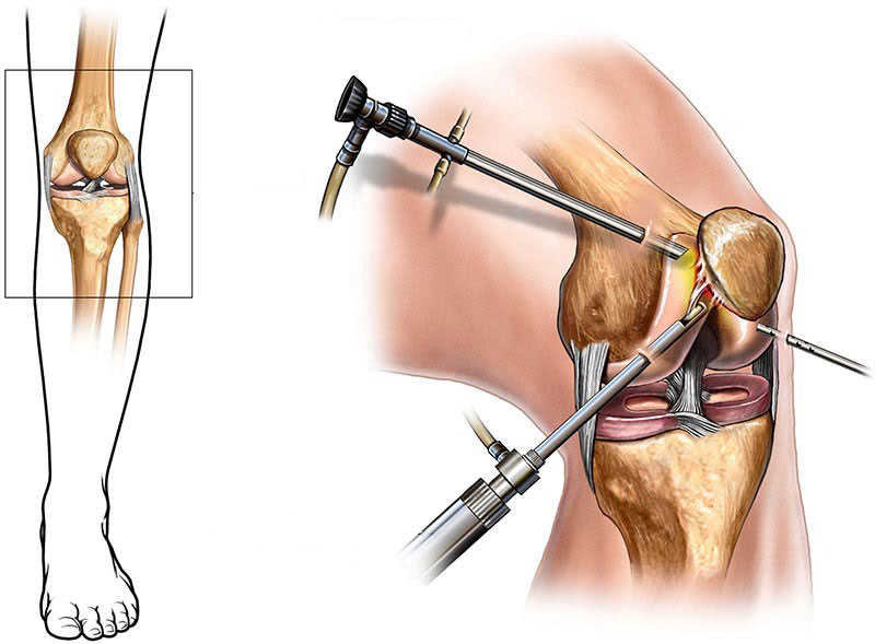 артроскопия артроскопия