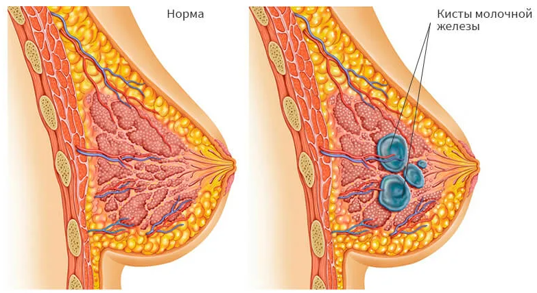 киста молочной железы