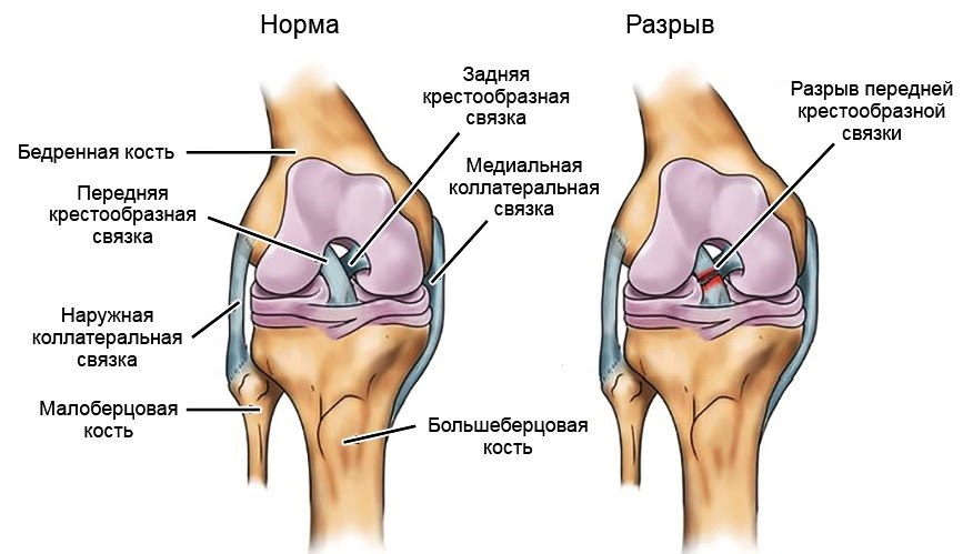 разрыв передней крестообразной связки