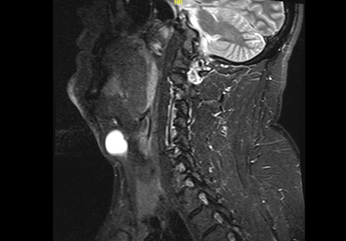 срединная киста шеи