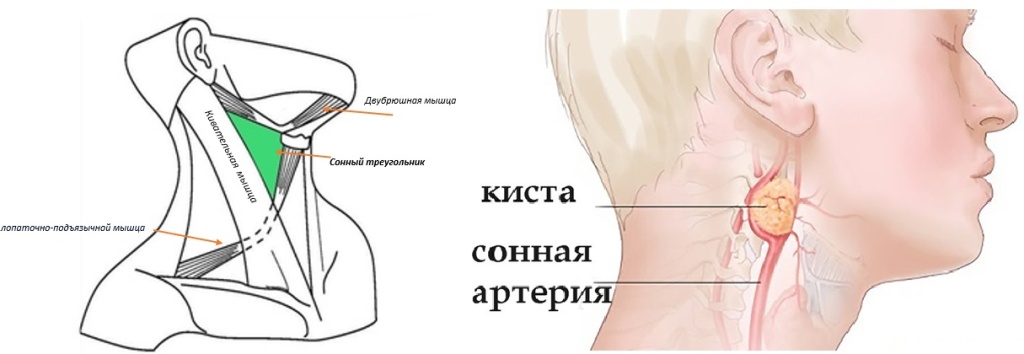 боковая киста шеи_1