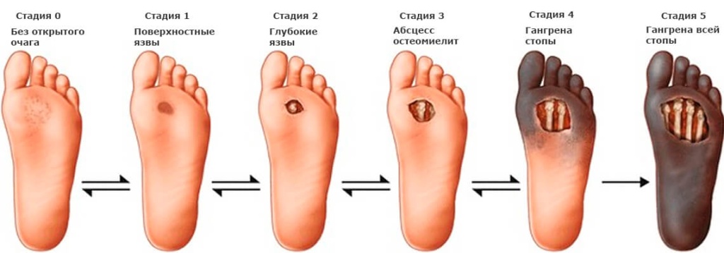 Стадии диабетической стопы Стадии диабетической стопы