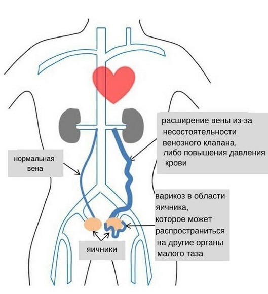 варикоз малого таза