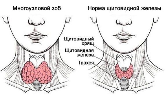 многоузловой зоб
