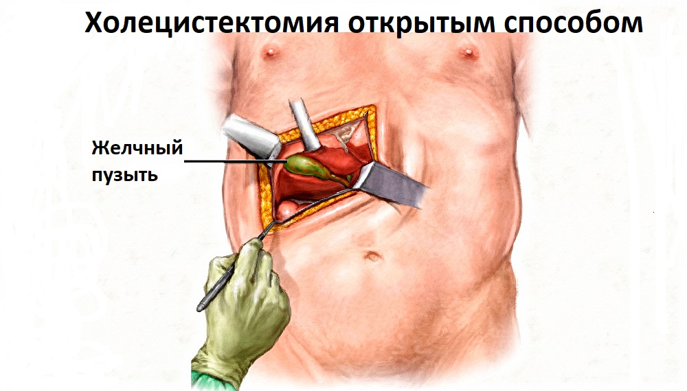 Операция по удалению желчного пузыря Операция по удалению желчного пузыря