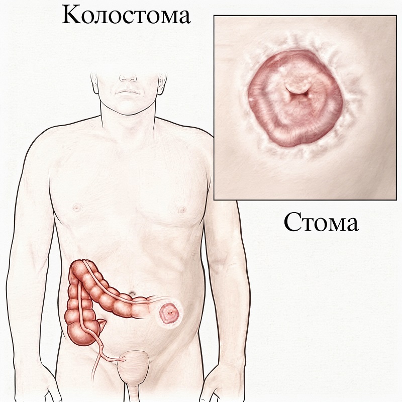 Выведение колостомы