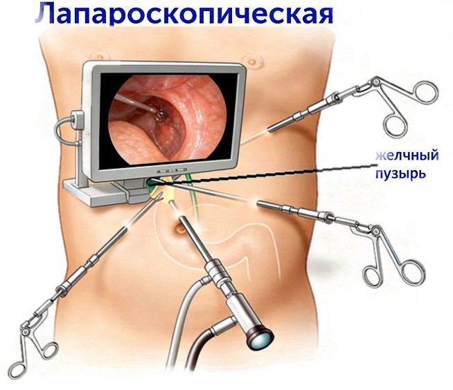 Лапароскопическая холецистэктомия