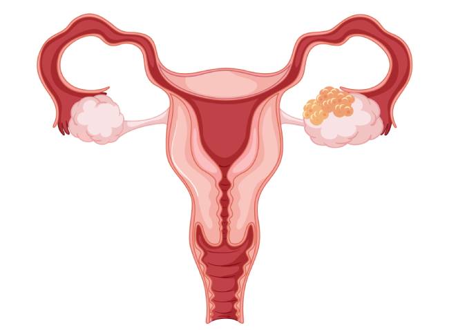 рак яичников первые признаки и симптомы