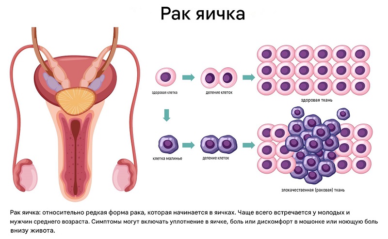 Патогенез рака яичка Патогенез рака яичка