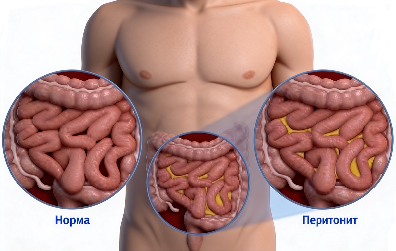 Перитонит - симптомы и признаки Перитонит - симптомы и признаки