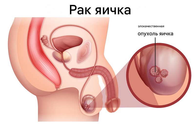 Причины рака яичек Причины рака яичек