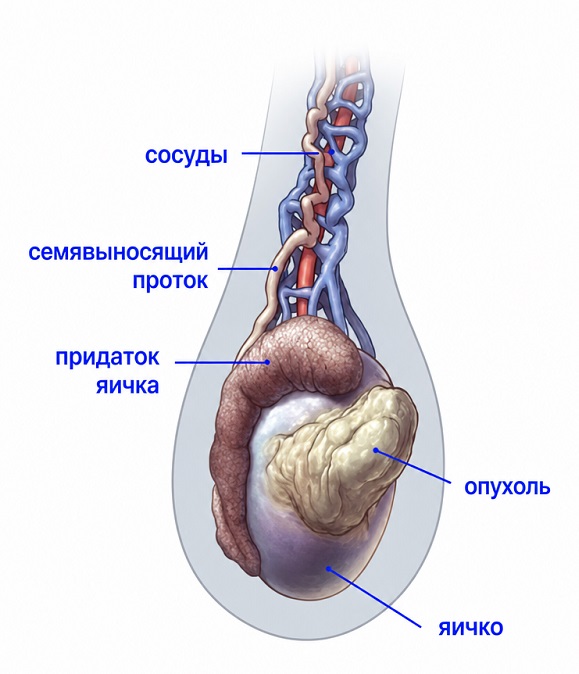 Рак яичка симптомы