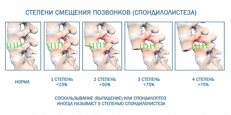 Антелистез степени