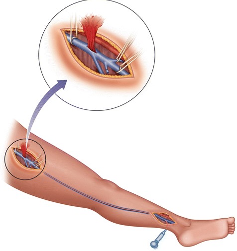 Как проводится тромбэктомия Химиотерапия при раке