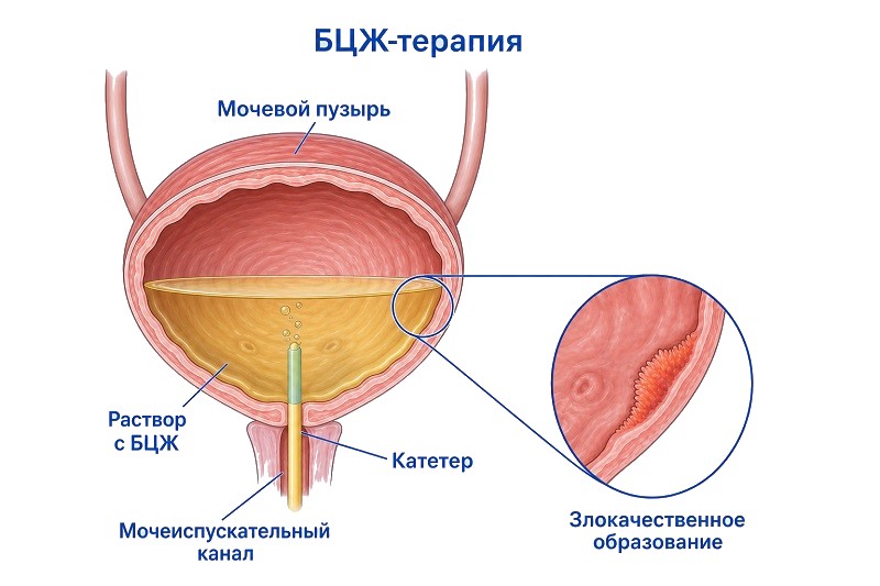 Вакцина БЦЖ Вакцина БЦЖ